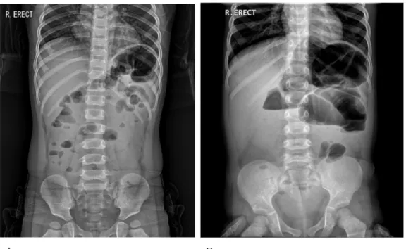 Figure 4. Ileus. (A) Paralytic ileus. This erect abdominal radiograph shows small multiple air-fluid levels (B) Mechanical ileus.