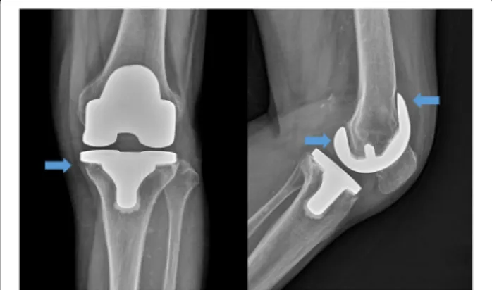 Fig. 3 Postoperative plain radiograph of resection arthroplasty. The infected prosthesis was removed, and antibiotic-mixed cement was placed on the articular side of the femur and tibia