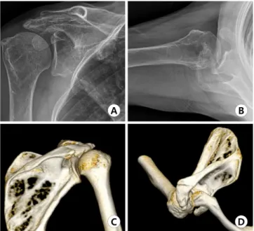 Fig. 1. Plain radiographs (A, B) and three-dimensional computed  tomography (C, D) scan showed a slightly displaced acromial  frac-ture through the posterior to the acromioclavicular joint and  superi-or migration of the humeral head.