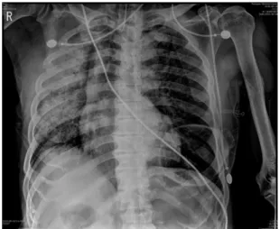 Fig. 1. Immediate postoperative chest X-ray. Diffuse air space  consolidation is shown in right lung.