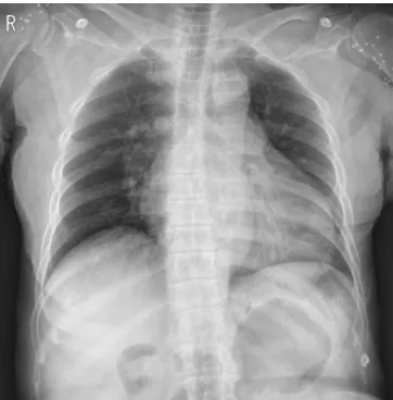 Fig. 2. Chest CT scan showing a small amount of pneumothorax  in the left hemithorax (arrows).