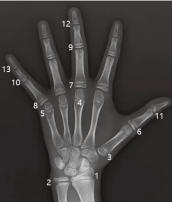 Fig. 1.  Thirteen short bones in the hand and wrist observed in  the scoring system based on the radius, ulna, and short bones