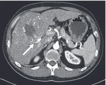 Figure 1. Initial dynamic computed tomography scan findings. A single 12.2 cm wide mass in segment VIII-V showed enhancement in the arterial  phase (A), and washout in the portal-phase (B) and the delayed phase (C).