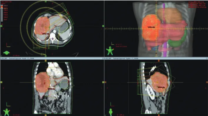 Figure 3. Planning computed tomography scan for stereotactic body radiation therapy. We planned to target the entire hepatocellular mass.