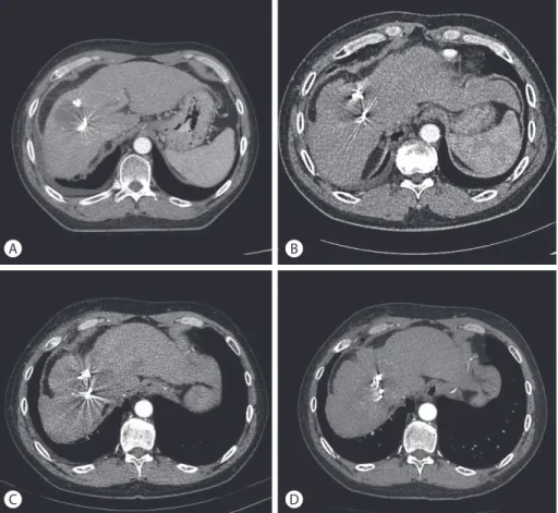 Figure 5. Findings on follow-up dynamic computed tomography scan after stereotactic body radiation therapy (SBRT)