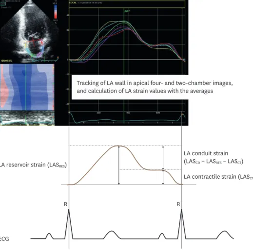 Figure 1. Demonstration of LA strain measurement. ECG: electrocardiography, LA: left atrium.