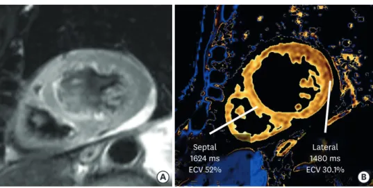 Figure 1. Cardiac computed tomography showing no significant coronary artery stenosis