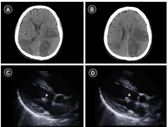Fig. 1. Findings of brain computed tomography (CT) and transthoracic echocardiogram (TTE)