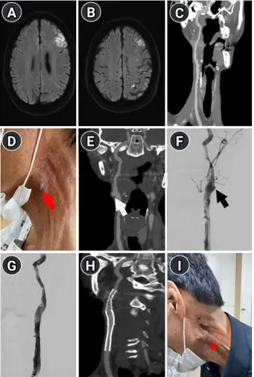 Fig. 1. (A, B) Cortical and border-zone infarctions in the left  cerebral hemisphere. (C) Multifocal long-segment stenosis  of the left common carotid artery extending to the proximal  internal carotid artery on computed tomography angiography