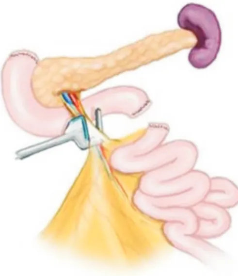 Fig. 14. The surgical stapling device is placed immediately below the  middle colic vessels.