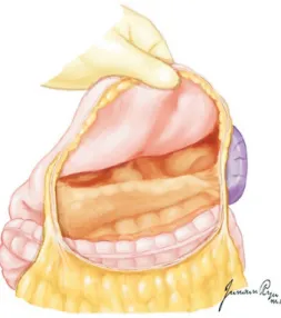 Fig. 16. The first portion of the duodenum is circumferentially dissected,  and a mechanical stapler is used to divide the duodenum from the  stom-ach just distal to the pylorus