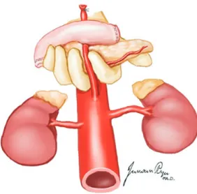 Fig. 19. The procurement of the common, external, and internal iliac  arteries is performed for Y-graft interposition at the time of back-table  procedures.