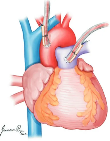 Fig. 2. The pulmonary artery (PA) is divided in the site where the cannula  was inserted in the distal main PA while ensuring the left and right PA are  not separated.