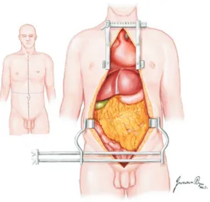 Fig. 7. A Cattell–Braasch maneuver extending across the midline, with  complete mobilization of the distal small bowel, right colon, and  duo-denum, allows for the identification of the distal aorta, iliac bifurcation,  and distal inferior vena cava