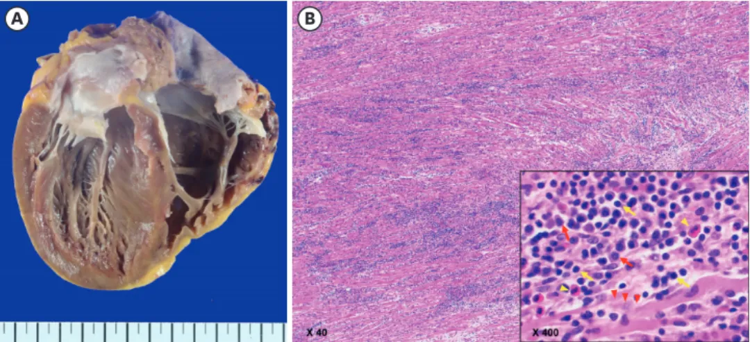 Figure 3. Gross specimen and microscopic findings of the explanted heart. Gross specimen shows enlarged  ventricular chambers (A), and H&amp;E stain shows lymphocyte dominant with plasma cell and eosinophil infiltration  (lymphocyte – yellow arrow, plasma 