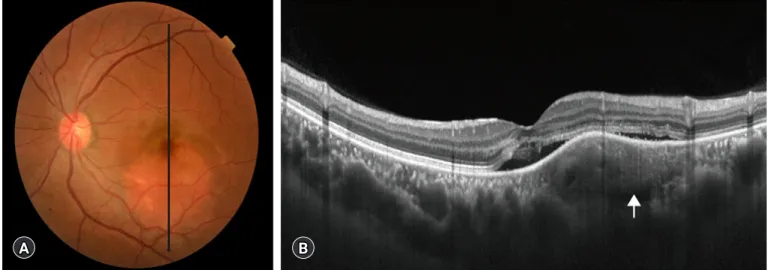 Fig. 1. Fundus photograph and optical coherence tomography of the left eye obtained on the initial visit