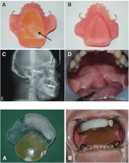 Fig. 2. Gel bolus (arrow) packed in relief  space within stent for irradiated spot (A)