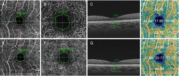 Figure 1. An example of swept-source optical coherence tomography angiography image from the right eye of 19-year-old female  with thyroid eye disease