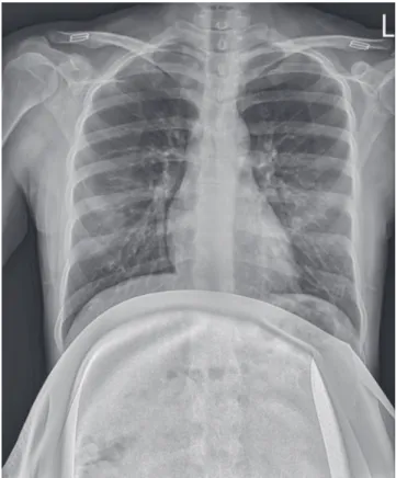 Fig. 1. Plain chest radiograph in the mother showed no definitive  pathologic findings.