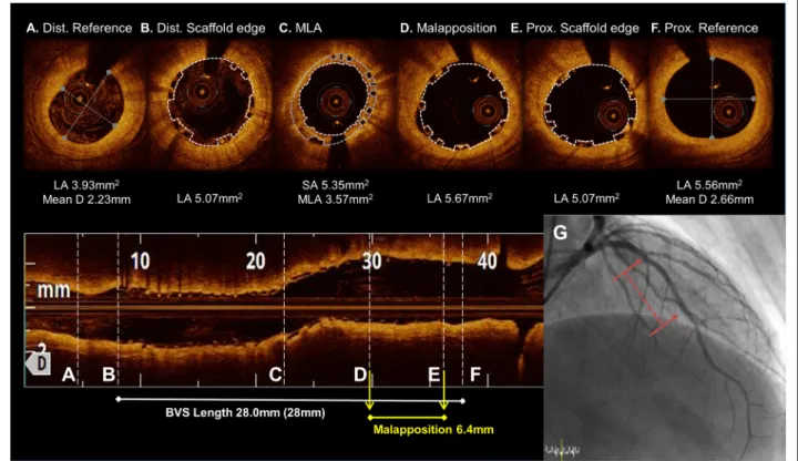 Fig. 1 The OCT images during the BVS implantation from the distal to proximal 2.5 × 28 mm BVS was deployed at a nominal pressure and post- post-dilated with a 2.75 mm noncompliance balloon at 16 atm
