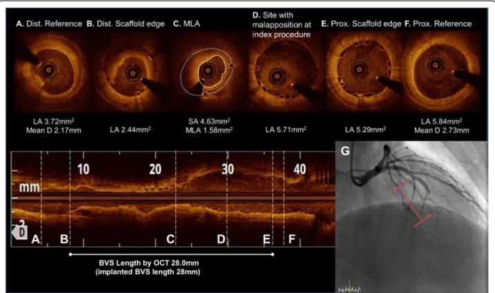 Fig. 2 OCT image during the subacute scaffold thrombosis event after a 2.5 mm preballoon dilatation up to 4 atm
