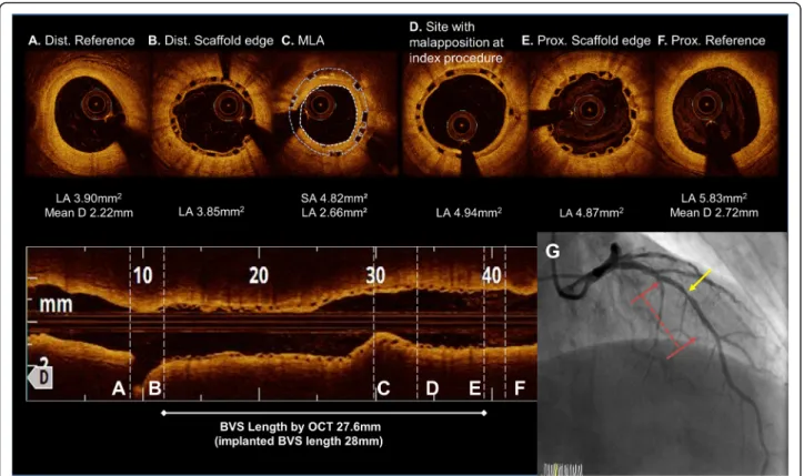 Fig. 3 OCT image at the one-year follow up after the BVS implantation. (a to f). The MLA site migrated to the proximal side of the BVS