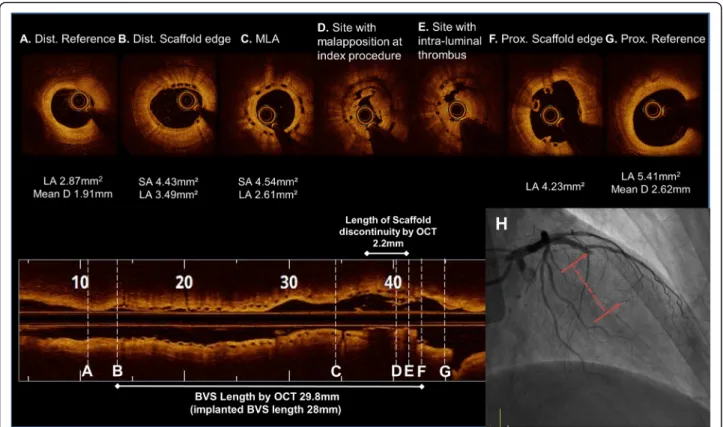 Fig. 4 OCT image during the very late scaffold thrombosis (VLScT) event after a 2.0 mm preballoon dilatation up to 4 atm (a to g)
