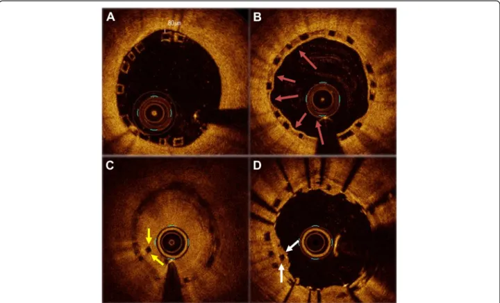 Fig. 5 An expanded serial OCT image of the same point during the initial procedure, the one-year follow up, and very late scaffold thrombosis (VLScT) event
