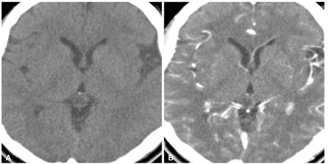 Fig. 1. CT scans of pineal cyst apoplexy. The ventricle width is normal (A) and the cyst is mildly enhanced at the periphery (B)