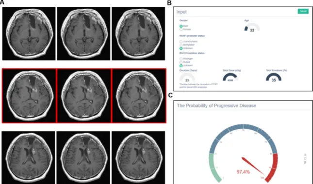 Figure 7. Example of incorrect prediction by the model. (A) Triplicate use of MR images was applied  due to the thick slice thickness (>1 mm)