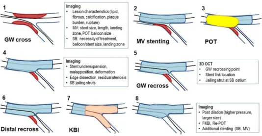 Fig. 3    Flow of imaging-guided  provisional bifurcation stenting. 