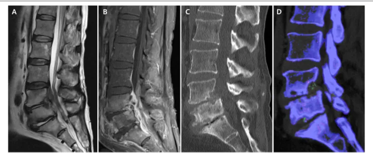 FIGURE 2 | Lumbar spine magnetic resonance imaging and computed tomography (CT) in axial gout