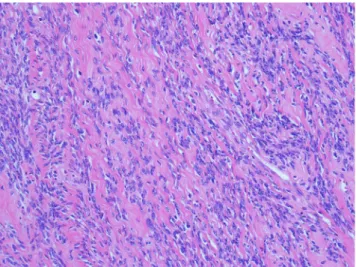 Fig. 3. Legend: STUMP showed spindle-cell proliferation, moderate atypia, and  absence of CTCN (H&amp;E x200)