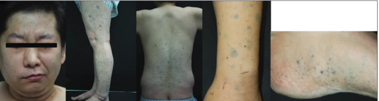 Figure 1a: Numerous grey‑bluish hyperpigmented macules and patches over the face, trunk and extremities