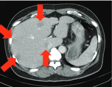 Figure 2a: Abdominal  computed  topography  scan  showed  hypo  intense 