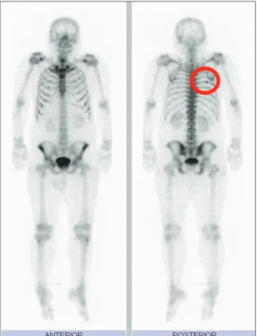 Figure 2e: Bone scan showed hot spot in the sixth rib