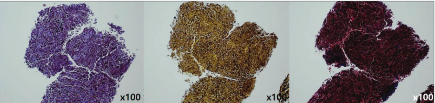 Figure 3d: Negative PAS, mucicarmine and trichrome (×100)
