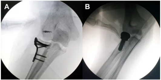 Figure 2. Assessment of elbow stability using valgus stress test after restoration of lateral structures