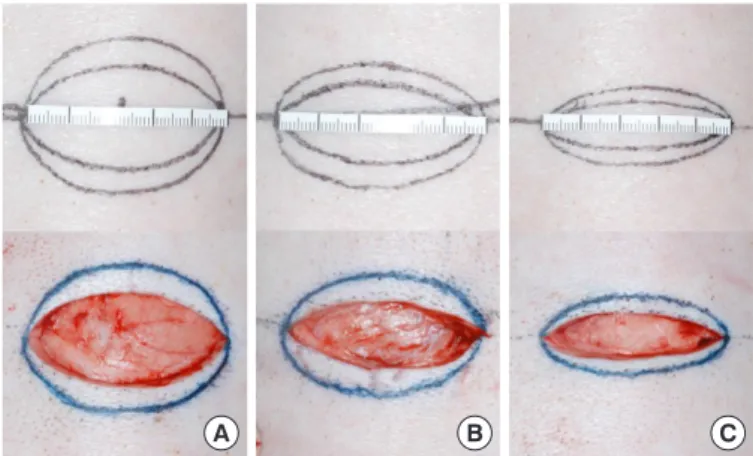Fig. 1. Design of the ellipse and first-stage excision patterns with  the same ratio of excision