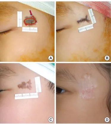 Fig. 4. Clinical application of the fish-fin design. (A) The position of  the fish fin (arrow) can be changed according to the geometric shape  of the lesion