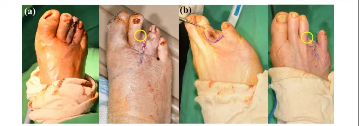 Figure 6. (a, b) After proximal phalanx was disarticulated, dissection toward all directions (arrow) was needed to cover the remained bone