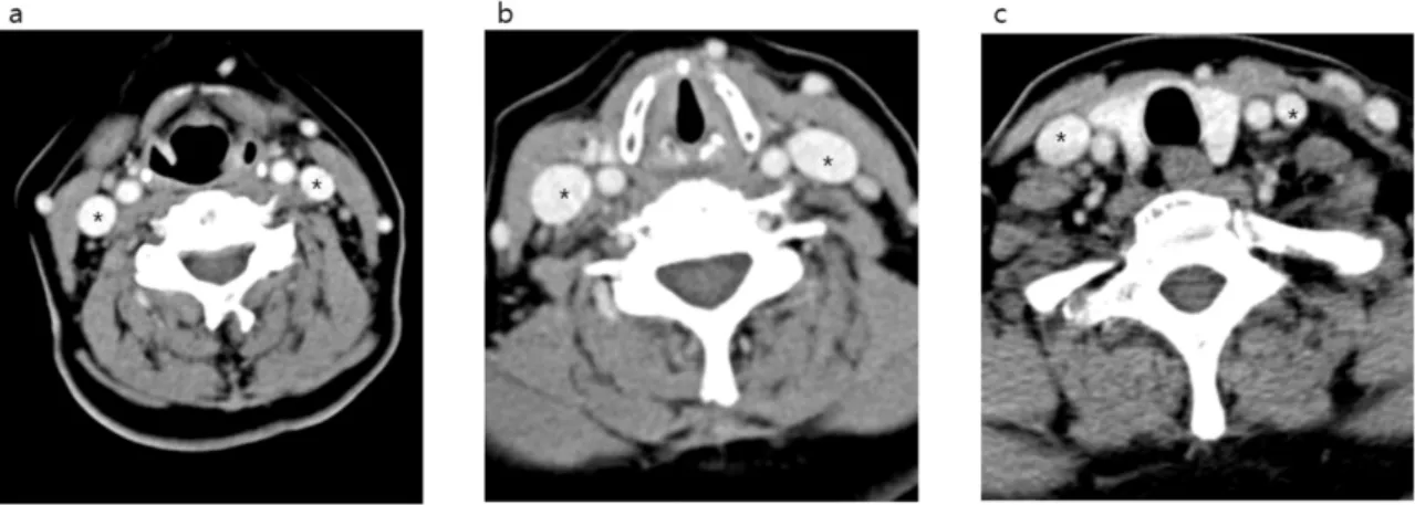 Figure 2. Neck computed tomography axial views of the internal jugular vein (*) and surrounding  structures in the anterior neck