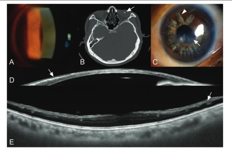Figure 1. Ocular siderosis at initial visit and 6 years after removal of intraocular foreign body