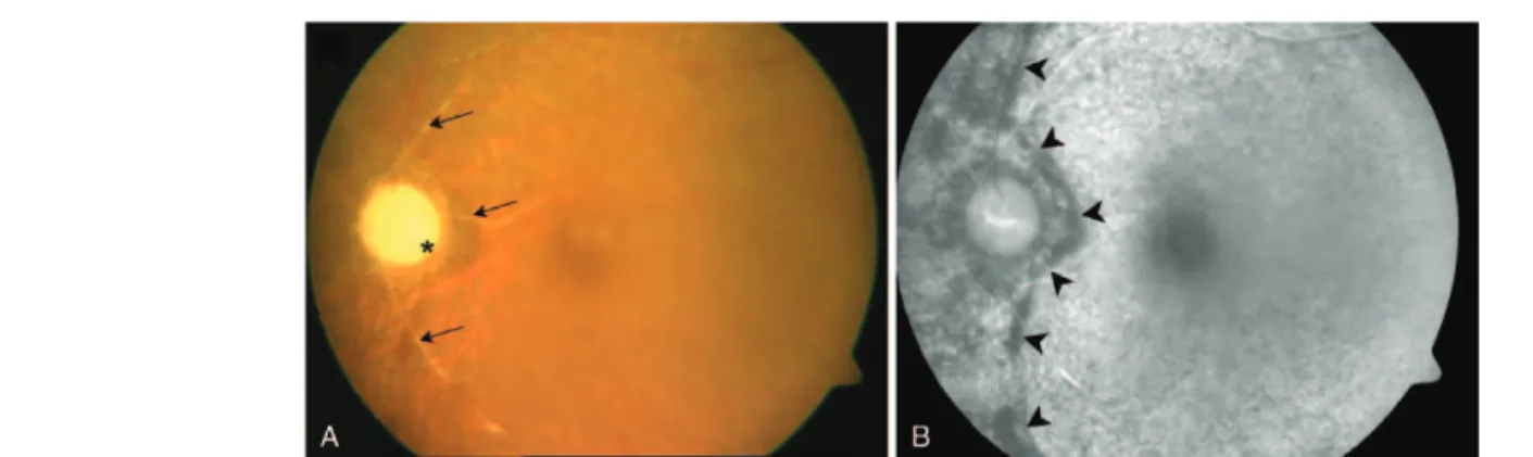 Figure 2. Elapsed computed tomography (CT) after brain aneurysm clipping surgery. (A) An immediate postoperative CT image of case 1 shows no proptosis