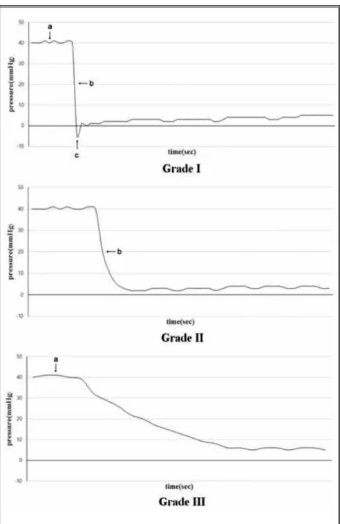 Fig. 3. Grade I showed the following characteristic components in sequence: (A) a highly  sustained positive pressure before entering the epidural space, (B) an abrupt pressure  decrease at the moment of  entering the epidural space with a tactile sensatio