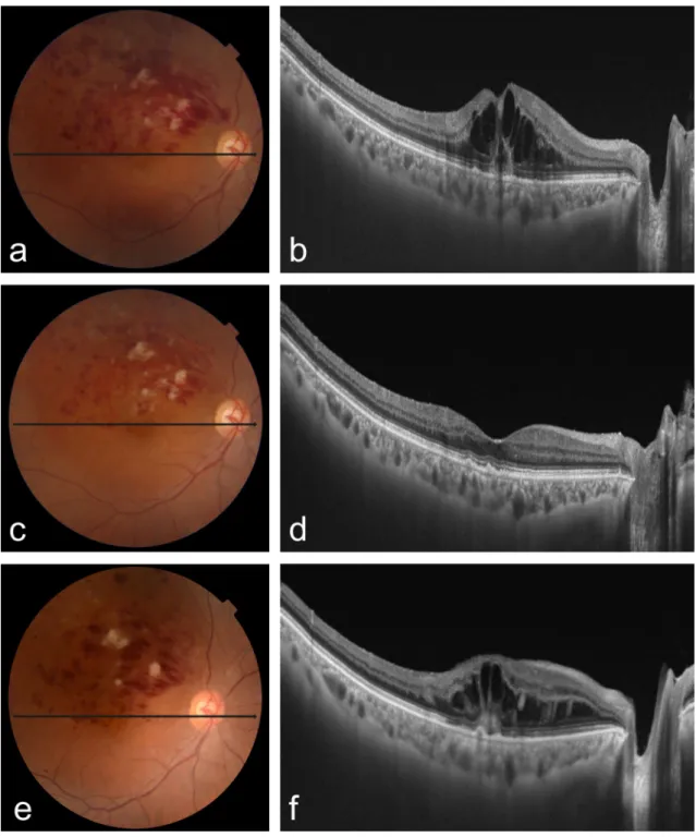 Figure 3.  Fundus colour photography and optical coherence tomography of ≥ 50% increased retinal 
