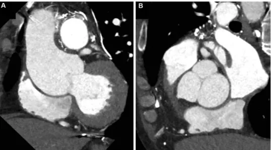 Figure 2: Preoperative computed tomography scan shows aortic root aneurysm (A). Tricuspid aortic valve shows asymmetricity with a central coaptation defect (B).