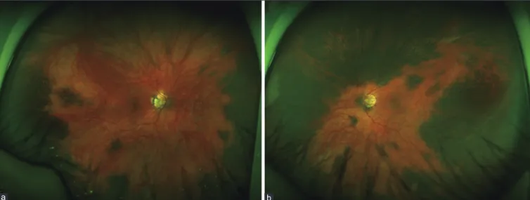 Figure  2:  Fundus  fluorescein  angiography  of  the  102°‑field  (a: right eye, b: left eye) and 55°‑field (c: right eye, d: left eye) showing  a normal angiographic pattern