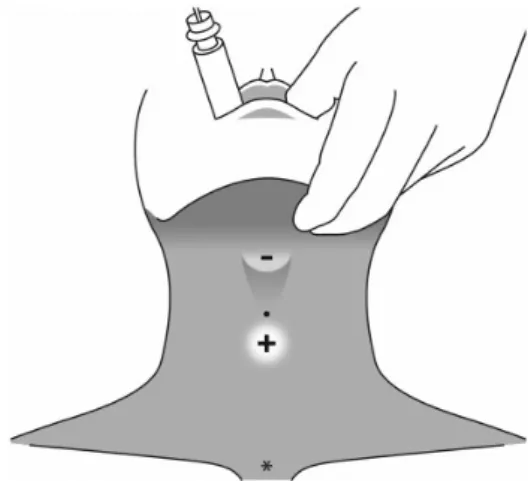 Figure 1. Tracheal intubation with a lightwand using a pre-marking point determined by a fibreoptic bronchoscope