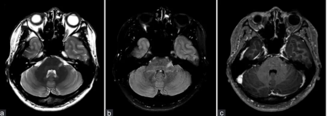 Figure 2: Brain MRI. (a) Axial T2-weighted and (b) fluid-attenuated inversion recovery images show a linear hyperintense lesion in the left pontine trigeminal root entry zone